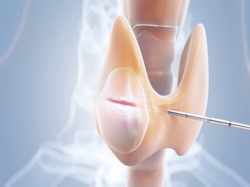 Đốt sóng cao tần là gì? Ưu, nhược điểm khi dùng đốt tuyến giáp