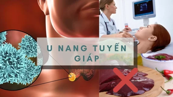 Nang tuyến giáp là gì? Ai dễ mắc phải bệnh, nguyên nhân gây ra