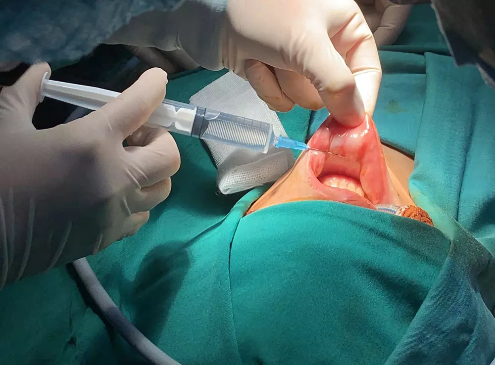 phương pháp phẫu thuật nội soi qua đường miệng