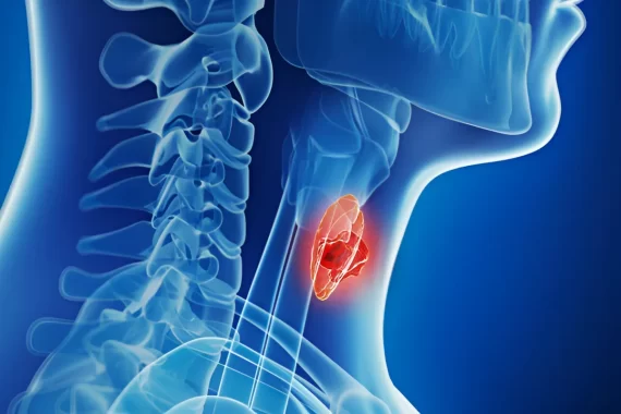 U tuyến giáp ác tính- Tiêu lượng sống của người mắc bệnh