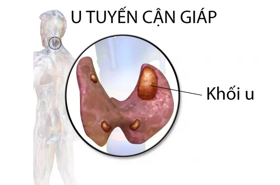 U tuyến cận giáp là gì? Triệu chứng nhận biết chuẩn nhất cần lưu ý