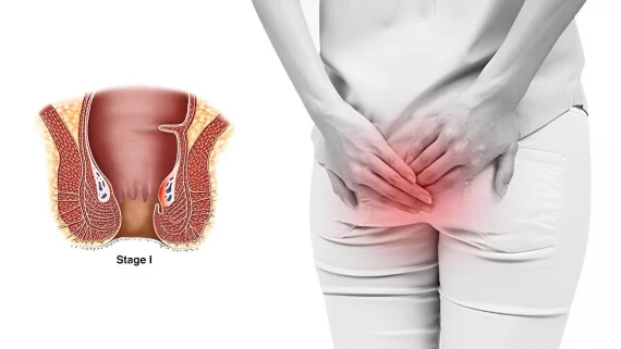 Bệnh trĩ giai đoạn đầu có thể điều trị bằng phương pháp nào?