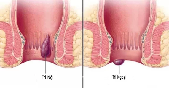 Mách bạn 6 cách chữa bệnh trĩ hiệu quả không nên bỏ qua