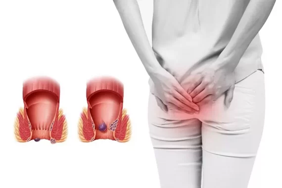 Các dấu hiệu bệnh trĩ nhẹ phổ biến nhất mà bạn nên biết