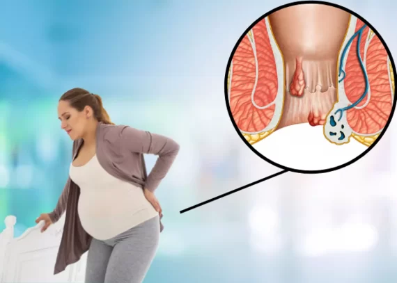 Dấu hiệu bị trĩ ở bà bầu và nguyên nhân gây bệnh nên biết