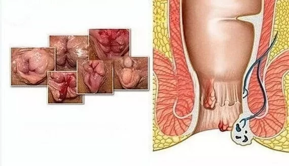 Hình ảnh trĩ độ 3: Nhận biết mức độ bệnh chuẩn xác nhất