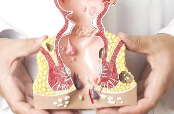 Sa búi trĩ là gì? Nguyên nhân, dấu hiệu và những biến chứng bệnh