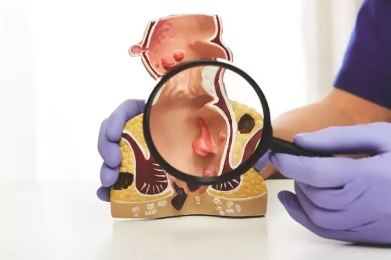 Trĩ nội độ 1: Các triệu chứng nhận biết bệnh chính xác nhất