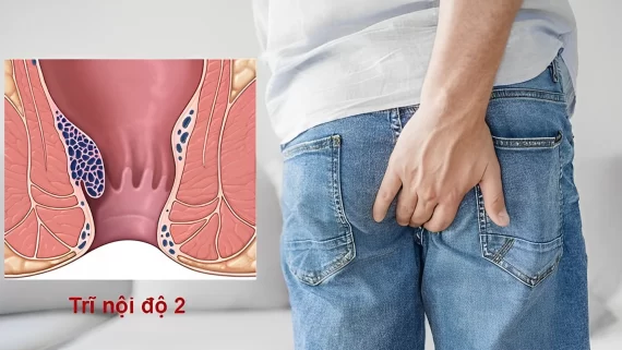 Trĩ nội độ 2 là gì? Các phương pháp điều trị bệnh hiệu quả nhất