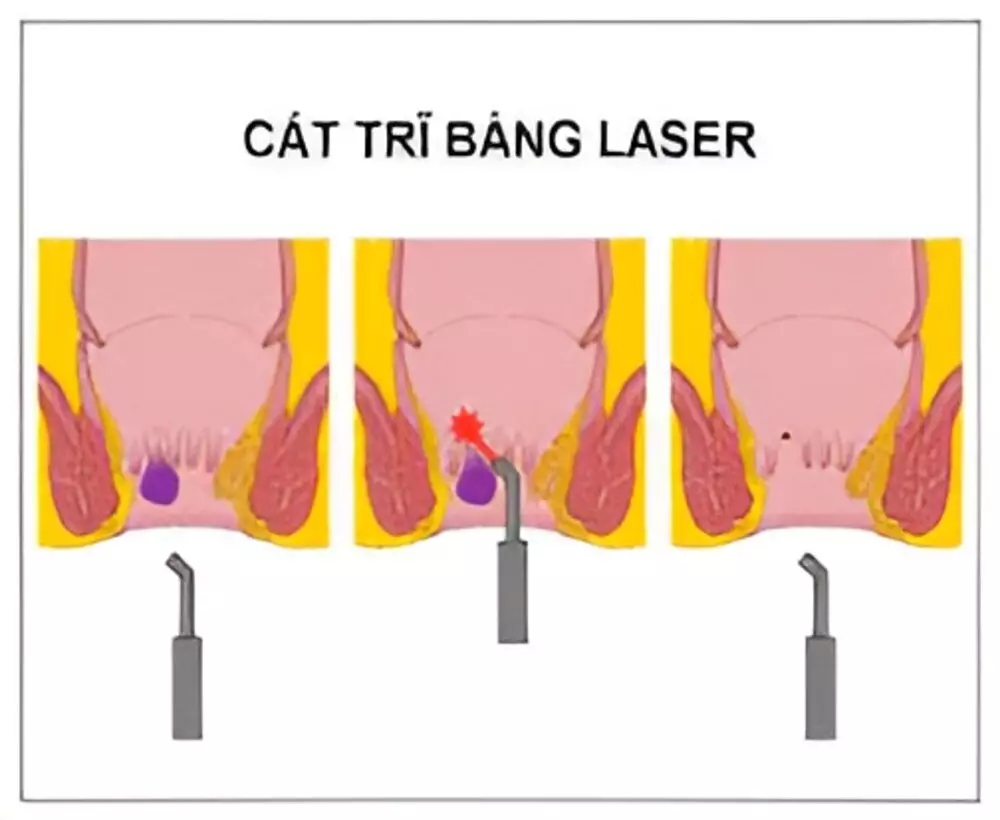 cắt trĩ bằng phương pháp đốt laser