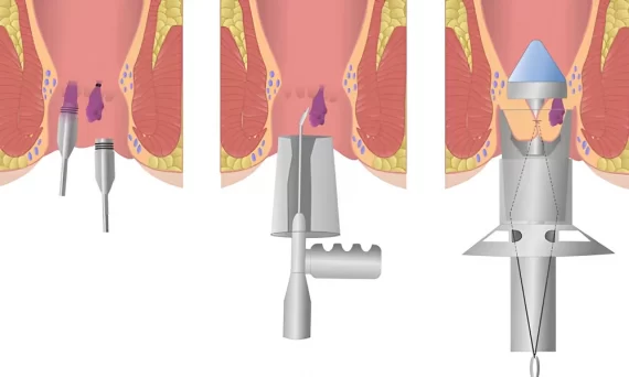 Cắt trĩ Longo là gì? Có nên sử dụng phương pháp này hay không?