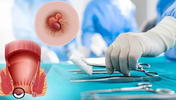 Cắt trĩ ngoại, nên hay không? Lời khuyên hữu ích từ chuyên gia