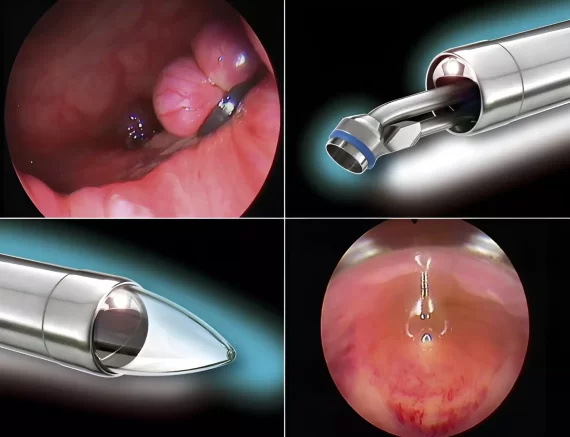 Nội soi trĩ là gì? Quy trình thực hiện nội soi trĩ như thế nào?