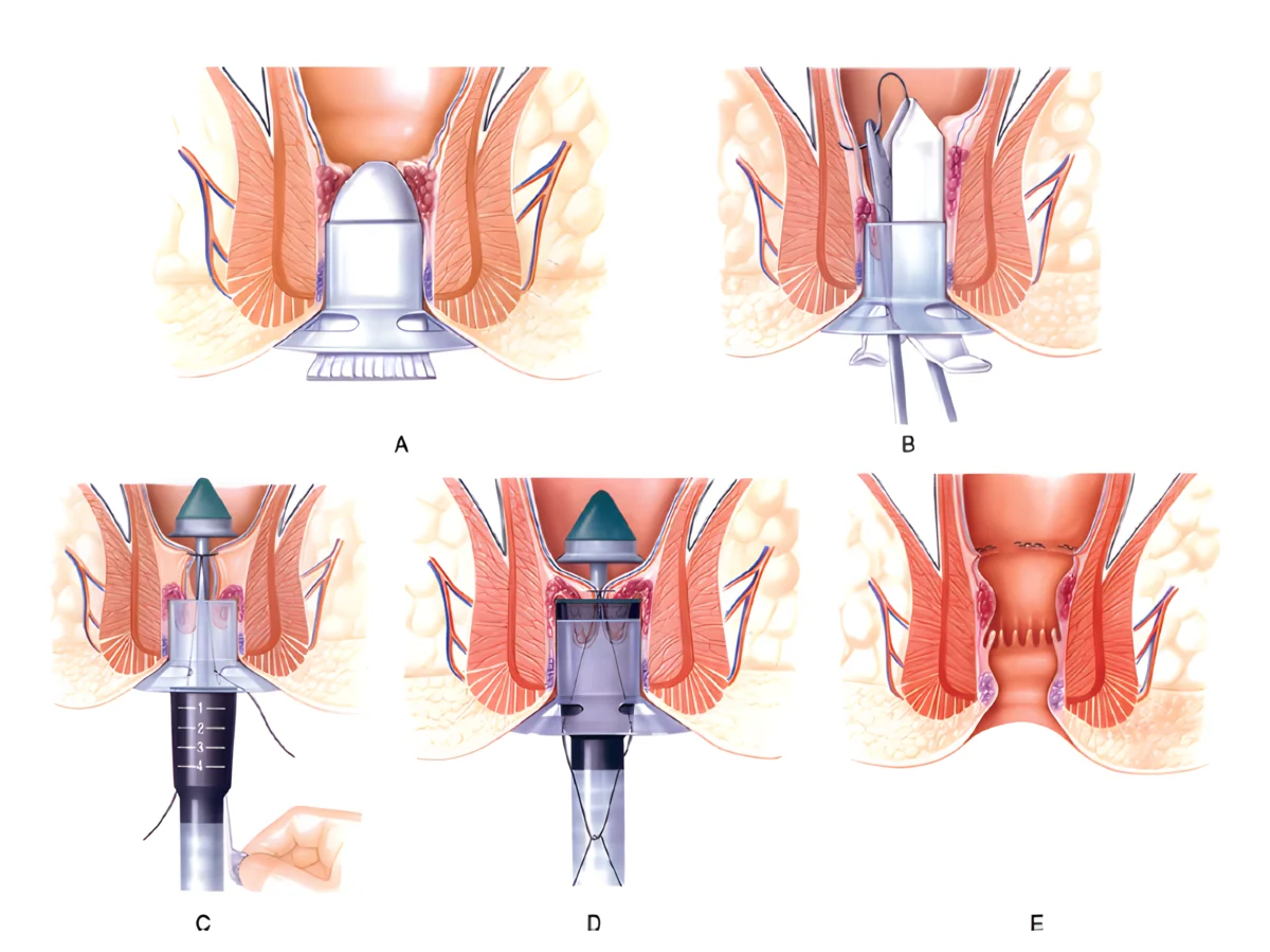 phương pháp cắt trĩ longo