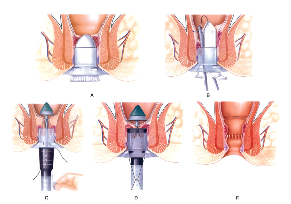 quy trình cắt trĩ bằng phương pháp longo