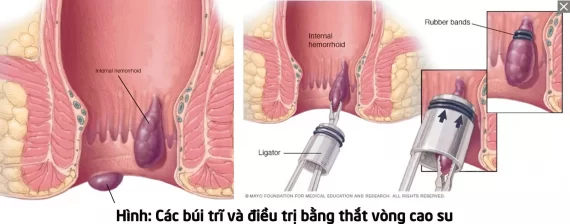 Thắt búi trĩ bằng vòng cao su nên hay không? Quy trình thực hiện