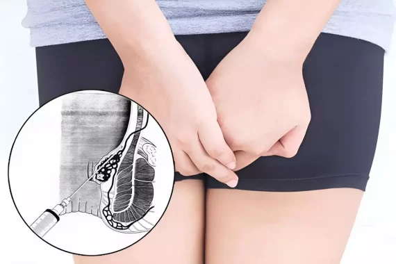 Tiêm xơ búi trĩ: Ưu và nhược điểm của phương pháp tiêm xơ búi trĩ