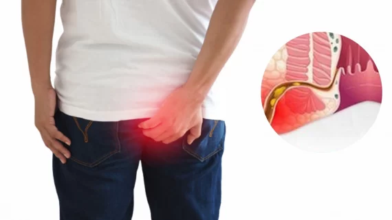 Trĩ ngoại độ 1 là gì? Các cách điều trị, lưu ý dành cho người bệnh