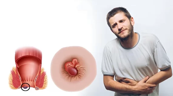 Trĩ ngoại độ 4 là gì? Cấp độ bệnh này có nguy hiểm không?