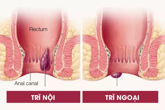 Tư vấn bệnh trĩ từ A-Z: Đầy đủ, chính xác nhất bạn nên tham khảo