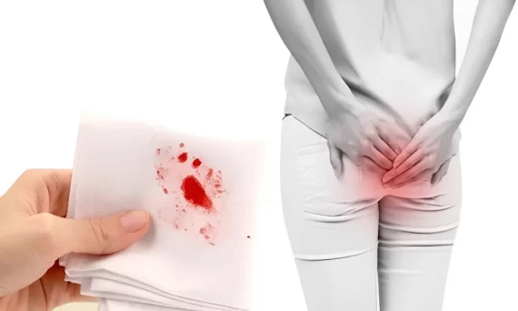 Trĩ bị hoại tử có nguy hiểm không? Phương pháp điều trị hiệu quả