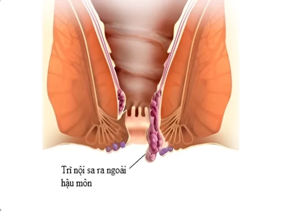 Búi trĩ lòi ra nhưng không đau có sao không? Tip xử lý hiệu quả