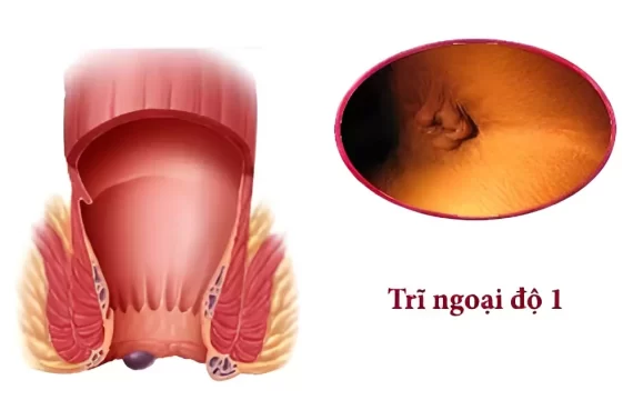 Cách chữa bệnh trĩ nhẹ đơn giản, an toàn, hiệu quả nhất hiện nay