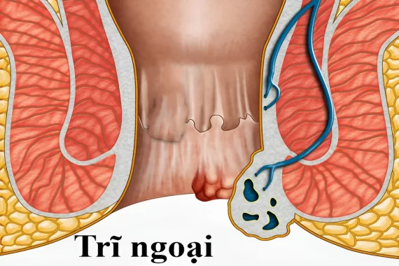 Trĩ ngoại là gì? Dấu hiệu nhận biết, mức độ nguy hiểm của bệnh