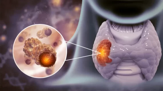 C73 u ác tuyến giáp là gì? Cách chẩn đoán và điều trị bệnh tốt nhất