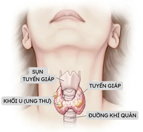 U tuyến giáp kích thước bao nhiêu phải mổ? Người bệnh cần biết!