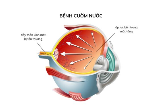 Bệnh cườm nước – Mất thị lực nhanh chóng chỉ vì nhầm lẫn và chủ quan