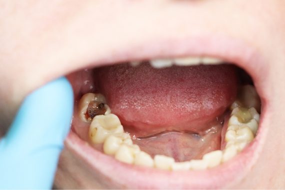 Nghịch lý: Thờ ơ với sâu răng mặc dù nguy cơ ảnh hưởng sức khoẻ nghiêm trọng