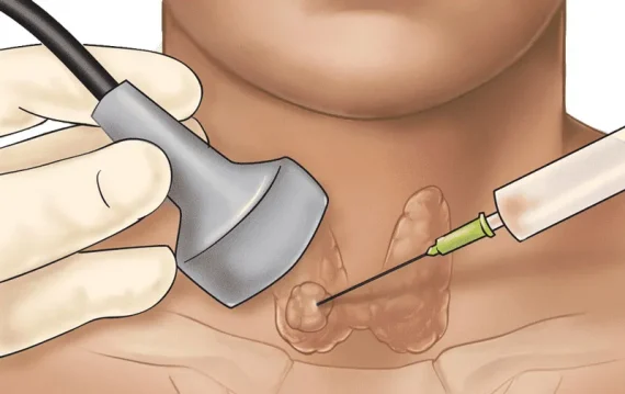 FNA tuyến giáp là gì? Giá trị của xét nghiệm FNA tuyến giáp?