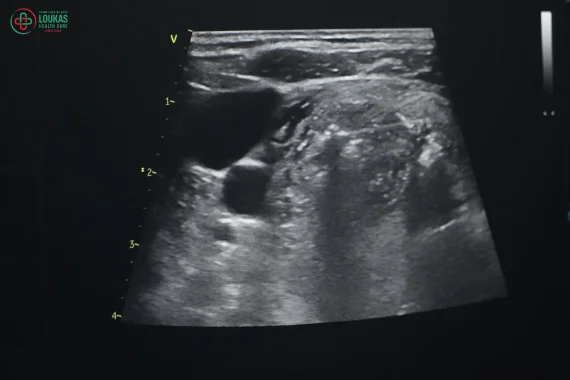 U tuyến giáp TIRADS 3 là gì? Nguyên nhân dấu hiệu của bệnh