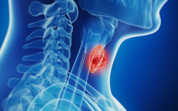 Đốt sóng cao tần RFA: Có loại bỏ u tuyến giáp lâu năm?