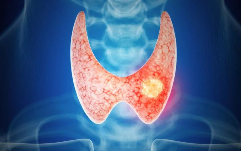 Phát hiện nhân tuyến giáp Tirads 3: Nên lo lắng hay chủ quan?