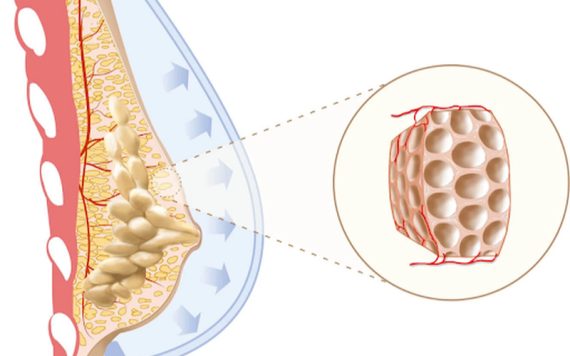 U xơ tuyến vú có tiến triển thành ung thư vú không?