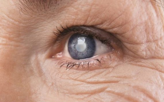 Đục thủy tinh thể người già: Nguyên nhân, dấu hiệu và cách điều trị