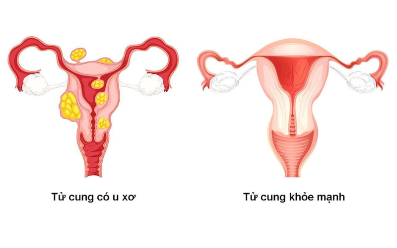 u xơ tử cung