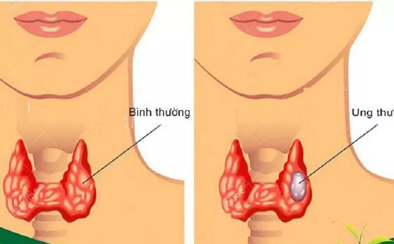 ung thư tuyến giáp thể nhú di căn hạch cổ là gì