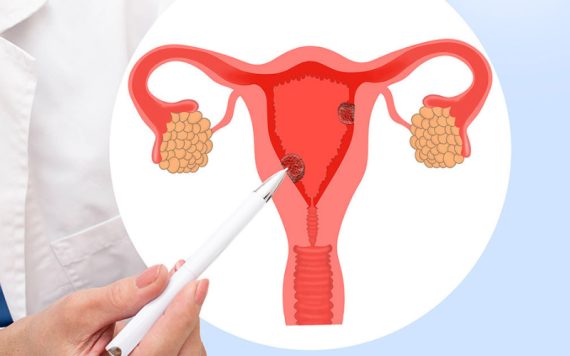 Hơn 5 triệu phụ nữ Việt Nam đang “chung sống” với buồng trứng đa nang