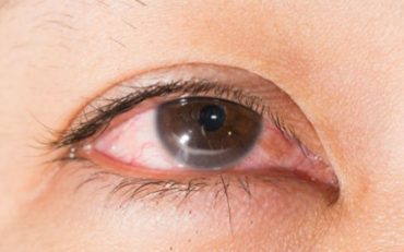 Viêm giác mạc: Vì sao mắt lại bị viêm? Làm thế nào để nhận biết và điều trị hiệu quả?