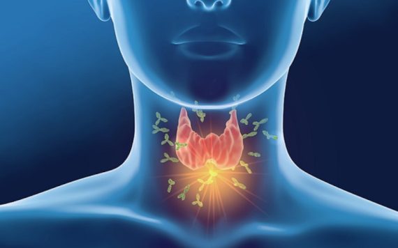 Giật mình phát hiện mình bị viêm giáp Hashimoto nhờ siêu âm tuyến giáp định kỳ