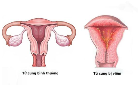 Đừng xem thường viêm nội mạc tử cung! Nguy cơ vô sinh cận kề nếu không được điều trị
