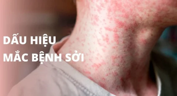 Bệnh sởi bùng phát mạnh, cần làm gì để phòng bệnh cho trẻ?