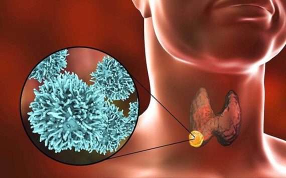 Bướu giáp nhân độc – Liệu có “độc” và nguy hiểm như tên?