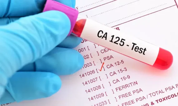 Xét nghiệm CA 125 tầm soát ung thư buồng trứng, là phụ nữ phải đọc ngay!