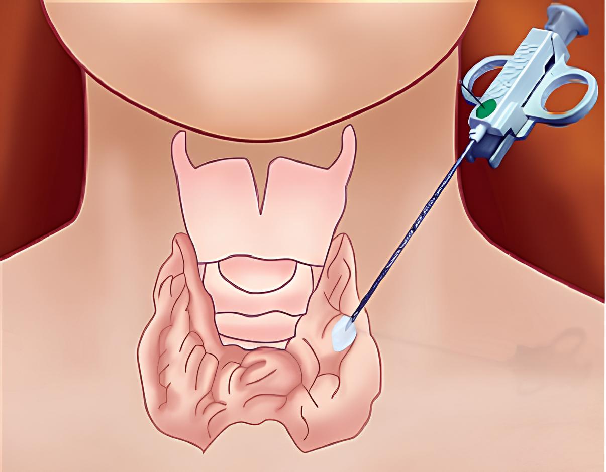 Sinh thiết tuyến giáp là gì? Có đau không và khi nào có kết quả?